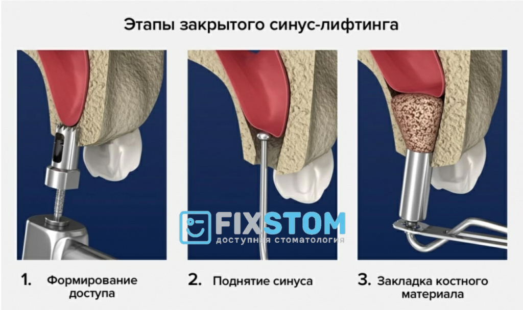 Закрытый синус лифтинг этапы Закрытый синус лифтинг этапы