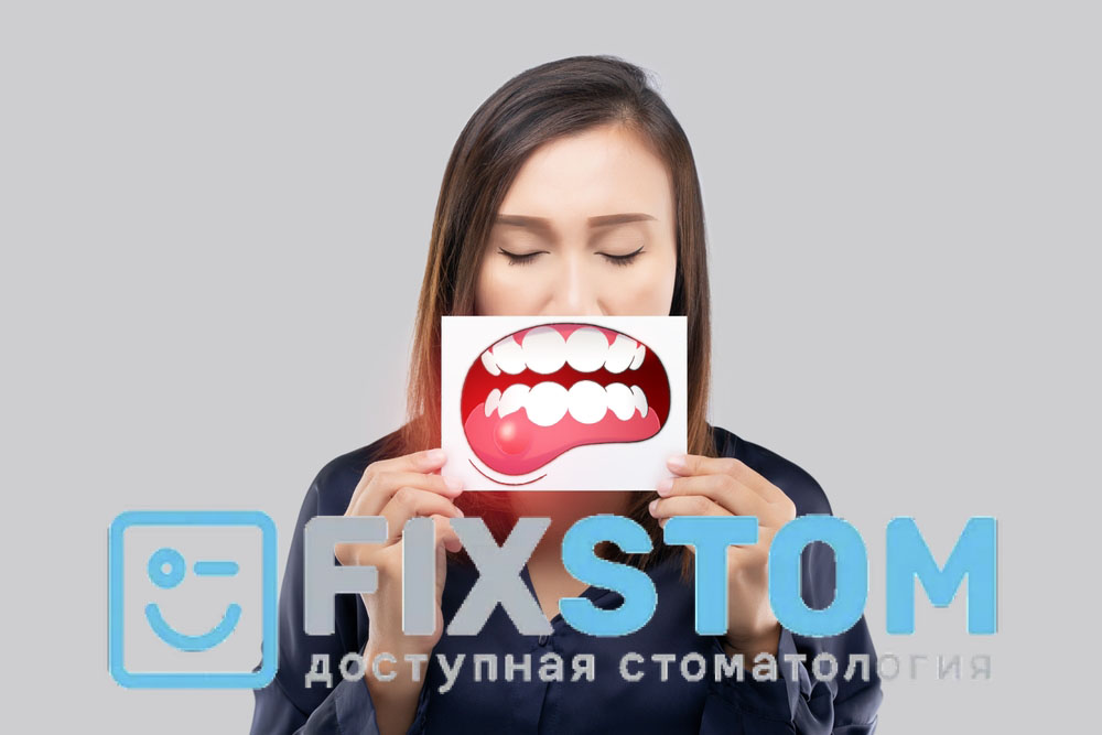 Гингивит