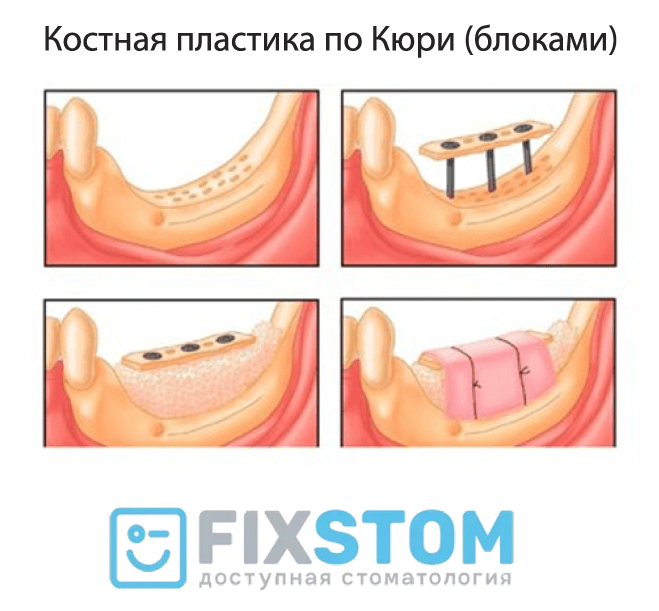 Костная пластика кости по Кюри Костная пластика кости по Кюри